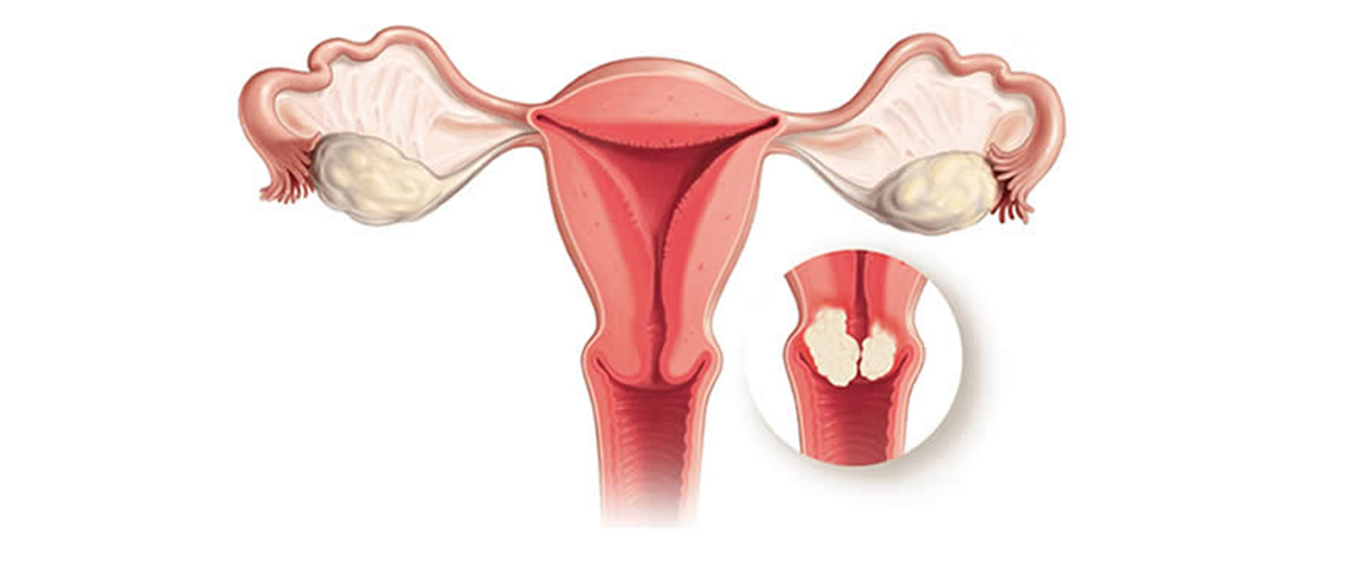 Endometirozis Nedir? - Endometriozis İstanbul