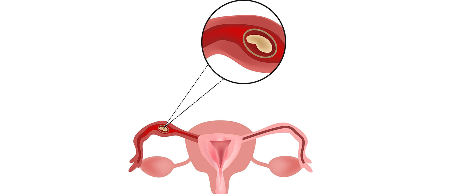 Внематочная эндометрий. Внематочная беременность операция. Внематочная беременность фото. Внематочная (эктопическая) беременность операция. Профилактика внематочной беременности.
