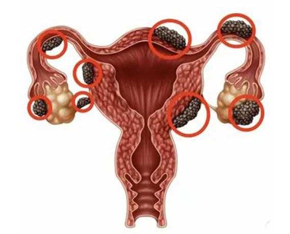 Endometriozis ve Çikolata Kistleri - Op. Dr. Ali Gürsoy