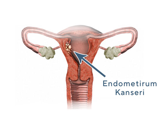 endometrium kanseri- Op. Dr. Ali Gürsoy