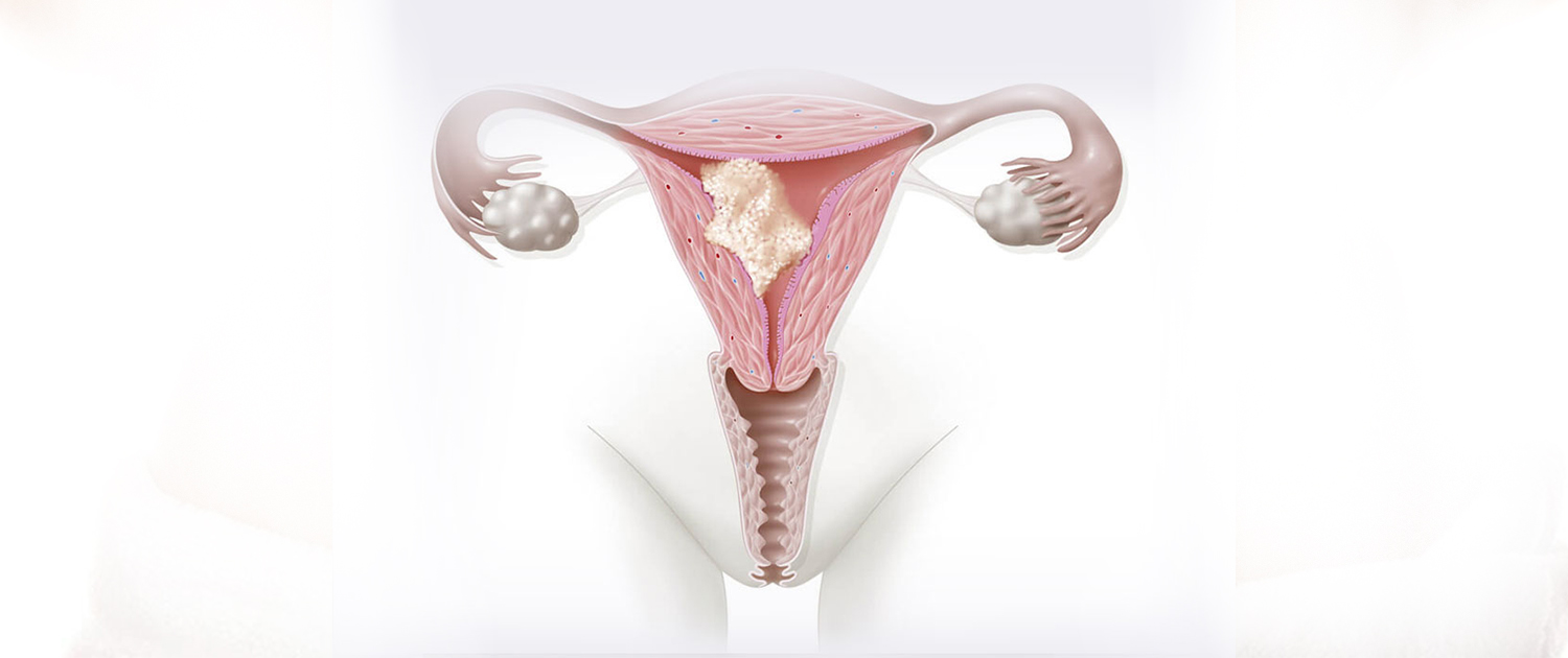 Endometirozis Nedir? - Endometriozis İstanbul